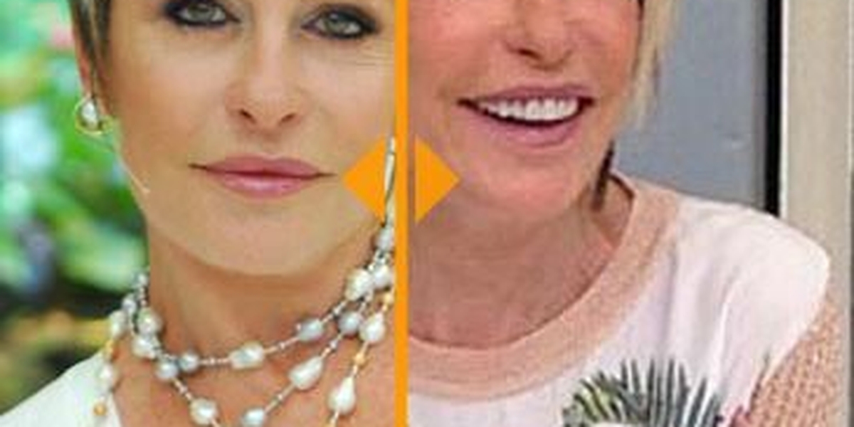 Confira O Antes E O Depois Das Famosas Que Aderiram Ao Botox Guiame