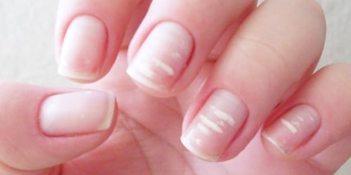 Saiba Como Remover Manchas Brancas Nas Unhas Guiame