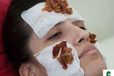 acne facial