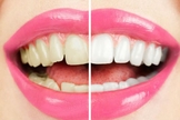 clareamento de dentes