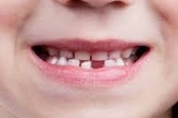 Dentes de leite