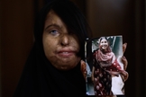 Naila Farhat, de 22 anos, é uma paquistanesa sobrevivente a um ataque com ácido. A jovem segura uma foto que mostra seu rosto antes do ataque. (Foto: AP)