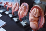 Bebês são desmembrados por médicos abortistas em clínicas de aborto. (Foto: Scott Olson/Getty Images)