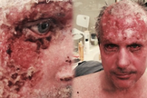 Chris ficou com mais de 20% de seu corpo com queimaduras. (Foto: Reprodução).