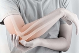 A osteoporose é um problema real e que afeta milhões de pessoas a nível mundial. (Foto: iStock)