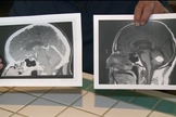 Imagem mostra exame tumor algum ao lado de exame com tumor. (Foto: CBS Sacramento)