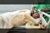 Ataque na Índia deixou Nitish Kumar, 14 anos, com queimaduras em 65% do corpo. (Foto: Morning Star News)