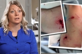 Casadi Schroeder foi atacada por um urso durante um acampamento bíblico no Canadá. (Foto: CBN News)