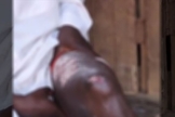 Yusufu mostra queimaduras de terceiro grau em uma das pernas. (Foto: Reprodução/Morning Star News)