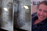 Carol Ann Turko compartilhou o antes e o depois de suas radiografias. (Foto: Reprodução/Facebook Carol Ann Turko))
