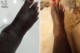 Imagens do antes e depois dos pés de uma mulher curados milagrosamente. (Foto: Facebook/