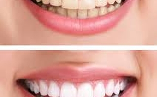 dentes amarelados