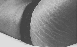 campanha contra estrias