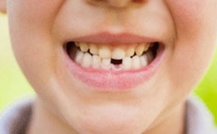 dente de leite
