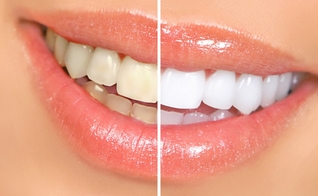 clareamento dental