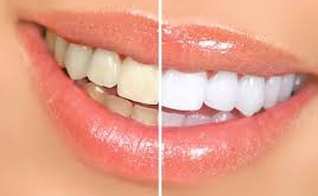dentes brancos