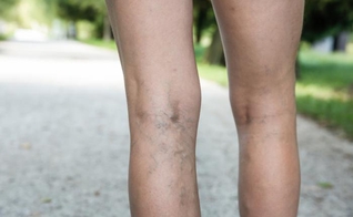 A aparição das varizes no corpo passam antes por um processo complexo. (Foto: Reprodução)
