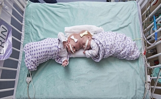 Gêmeas Erin e Abby Delaney no Hospital Infantil da Filadélfia, em setembro de 2016. (Foto: AP)