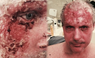 Chris ficou com mais de 20% de seu corpo com queimaduras. (Foto: Reprodução).