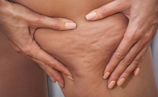 A celulite é uma inflamação que faz as células de gordura inchar. (Foto: dimid_86/Thinkstock/Getty Images)