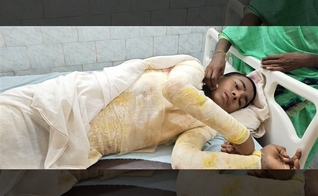 Ataque na Índia deixou Nitish Kumar, 14 anos, com queimaduras em 65% do corpo. (Foto: Morning Star News)