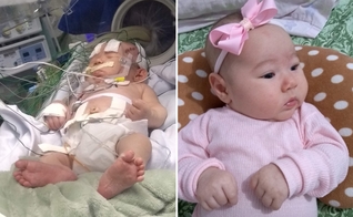 Sarah de Lima hoje, aos três meses; e, à esquerda, quando estava internada na UTI Neonatal com complicações em decorrência da hipoglicemia detectada com um dia de vida. (Foto: Reprodução/Mariane Lima)