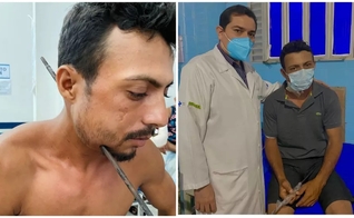 Na primeira imagem, Aldinailson com o ferro atravessado na lateral do pescoço; na segunda foto, ao lado do cirurgião geral Vinicius Savino, o paciente segura o ferro retirado na cirurgia. (Foto: Ascom HMS/Divulgação)