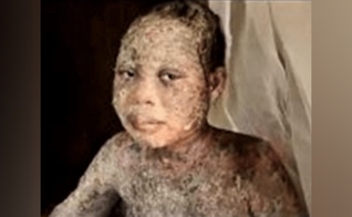 Amina Nagudi, de 13 anos, foi atacada com ácido junto com os pais, por aceitar Jesus, em Uganda. (Foto: Morning Star News). 
