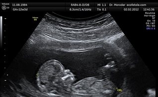 O uso de cloreto de potássio em abortos não é regulamentado no Brasil. (Foto: Wikimedia Commons/Wolfgang Moroder).