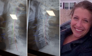 Carol Ann Turko compartilhou o antes e o depois de suas radiografias. (Foto: Reprodução/Facebook Carol Ann Turko))