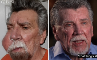 David Baker durante a doença e após sua cura. (Captura de tela/CBN News)