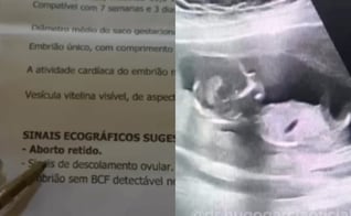 O Dr. Hugo Garcia compartilhou o testemunho, mostrando o bebê vivo no ultrassom. (Foto: Reprodução/Instagram/Dr. Hugo Garcia).