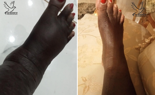 Imagens do antes e depois dos pés de uma mulher curados milagrosamente. (Foto: Facebook/
