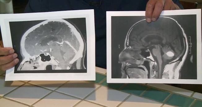 Imagem mostra exame tumor algum ao lado de exame com tumor. (Foto: CBS Sacramento)