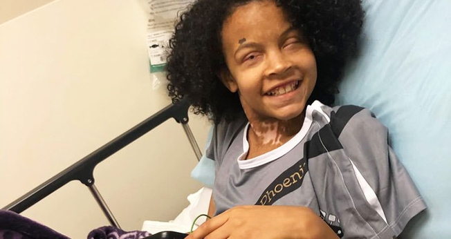 Phoenix Richey superou uma síndrome rara que afetou 65% de sua pele. (Foto: Facebook/Pray For Phoenix)