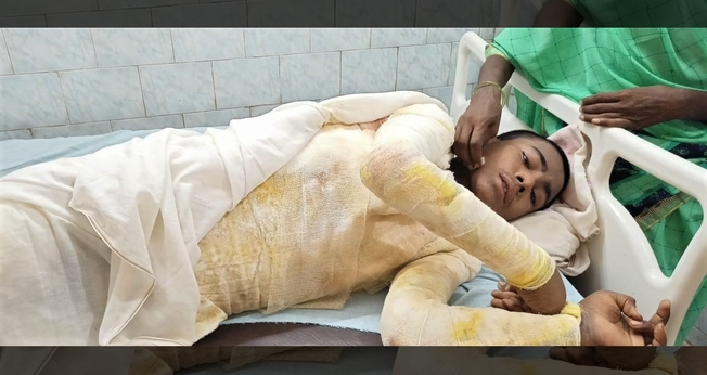 Ataque na Índia deixou Nitish Kumar, 14 anos, com queimaduras em 65% do corpo. (Foto: Morning Star News)