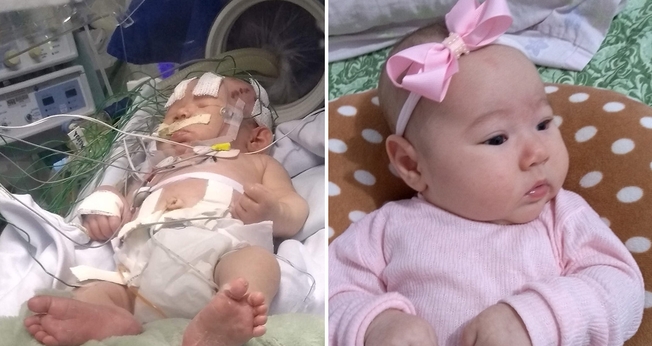 Sarah de Lima hoje, aos três meses; e, à esquerda, quando estava internada na UTI Neonatal com complicações em decorrência da hipoglicemia detectada com um dia de vida. (Foto: Reprodução/Mariane Lima)