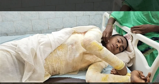 Nitish Kumar, de 16 anos, foi vítima de um ataque com ácido de extremistas hindus. (Foto: Morning Star News).