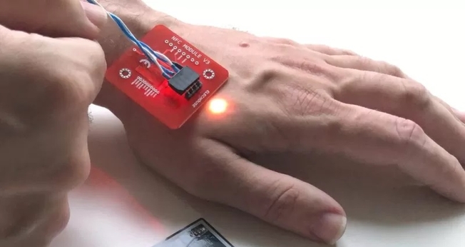 Um raio-x mostra um implante Walletmor, que é injetado na mão de uma pessoa após um anestésico local. (Foto: Reprodução / BBC)
