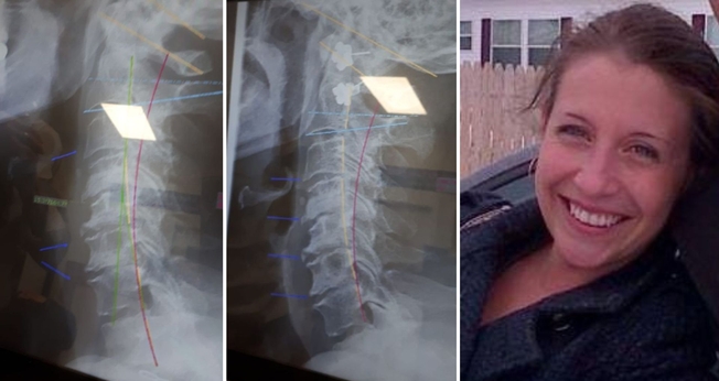 Carol Ann Turko compartilhou o antes e o depois de suas radiografias. (Foto: Reprodução/Facebook Carol Ann Turko))