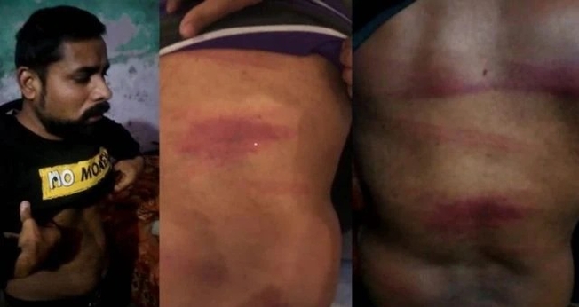 Azam Nasih mostra as marcas após o espancamento. (Foto: Reprodução/Bitter Winter)