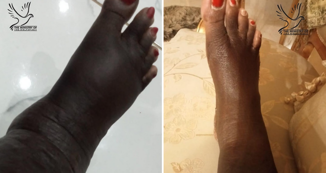 Imagens do antes e depois dos pés de uma mulher curados milagrosamente. (Foto: Facebook/