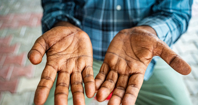 As cicatrizes de Kumar. (Foto: Reprodução/Global Christian Relief)