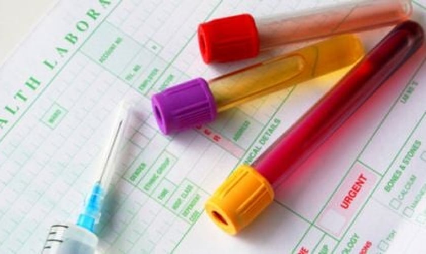 Coloração da urina pode revelar doenças renais ou do fígado
