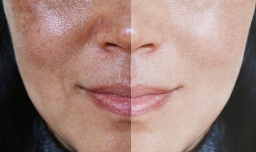 A tecnologia promete deixar a pele homogênea de forma mais efetiva. (Foto: Getty Images)