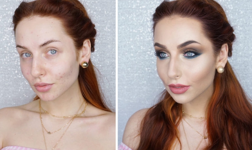 Existem truques de maquiagem que podem amenizar as acnes. (Foto: With Love Nadia)