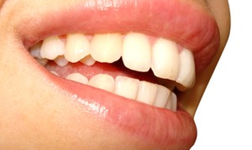 clareador dental