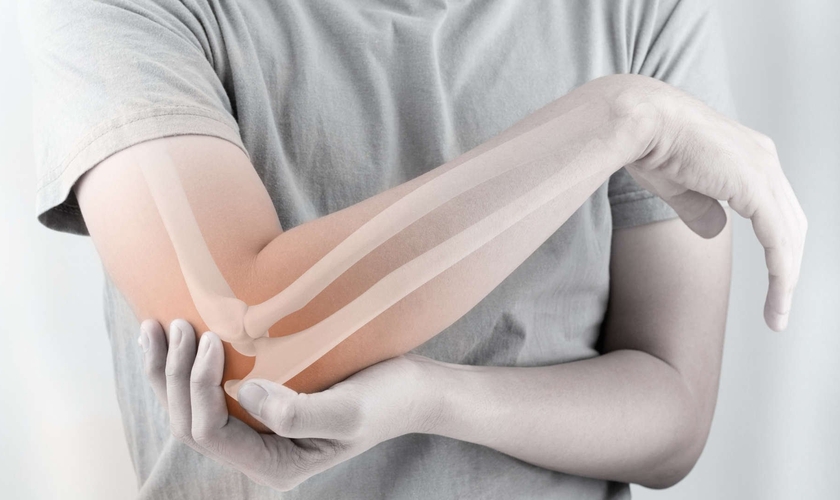 A osteoporose é um problema real e que afeta milhões de pessoas a nível mundial. (Foto: iStock)