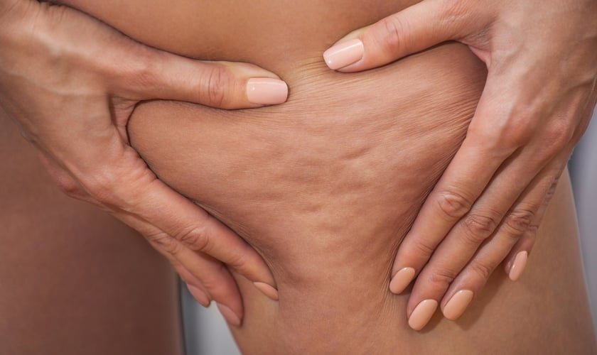 A celulite é uma inflamação que faz as células de gordura inchar. (Foto: dimid_86/Thinkstock/Getty Images)