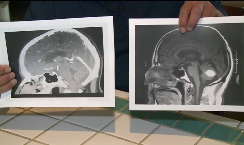 Imagem mostra exame tumor algum ao lado de exame com tumor. (Foto: CBS Sacramento)